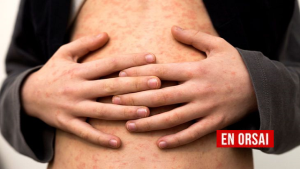 El avance del virus y la falta de políticas de inmunización generan preocupación en la comunidad médica